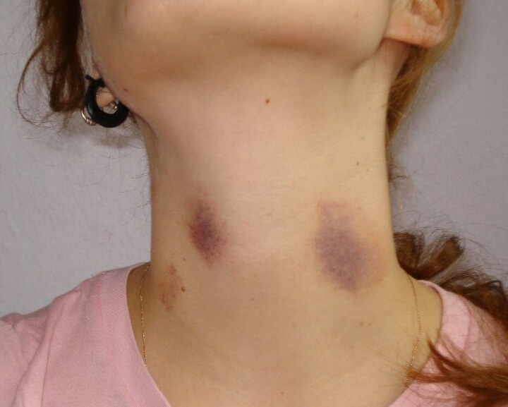 여자친구가 남긴 키스마크때문에 사망한 소년 | 인스티즈