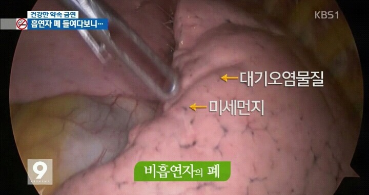 흡연자들의 폐 내시경.jpg (사진주의) | 인스티즈